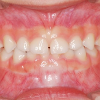 つくばこうた歯科クリニック｜歯科矯正イメージ