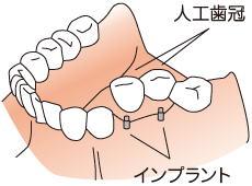 つくばこうた歯科クリニック｜インプラント図解