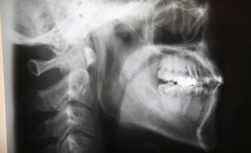 つくばこうた歯科クリニック｜歯周外科手術イメージ